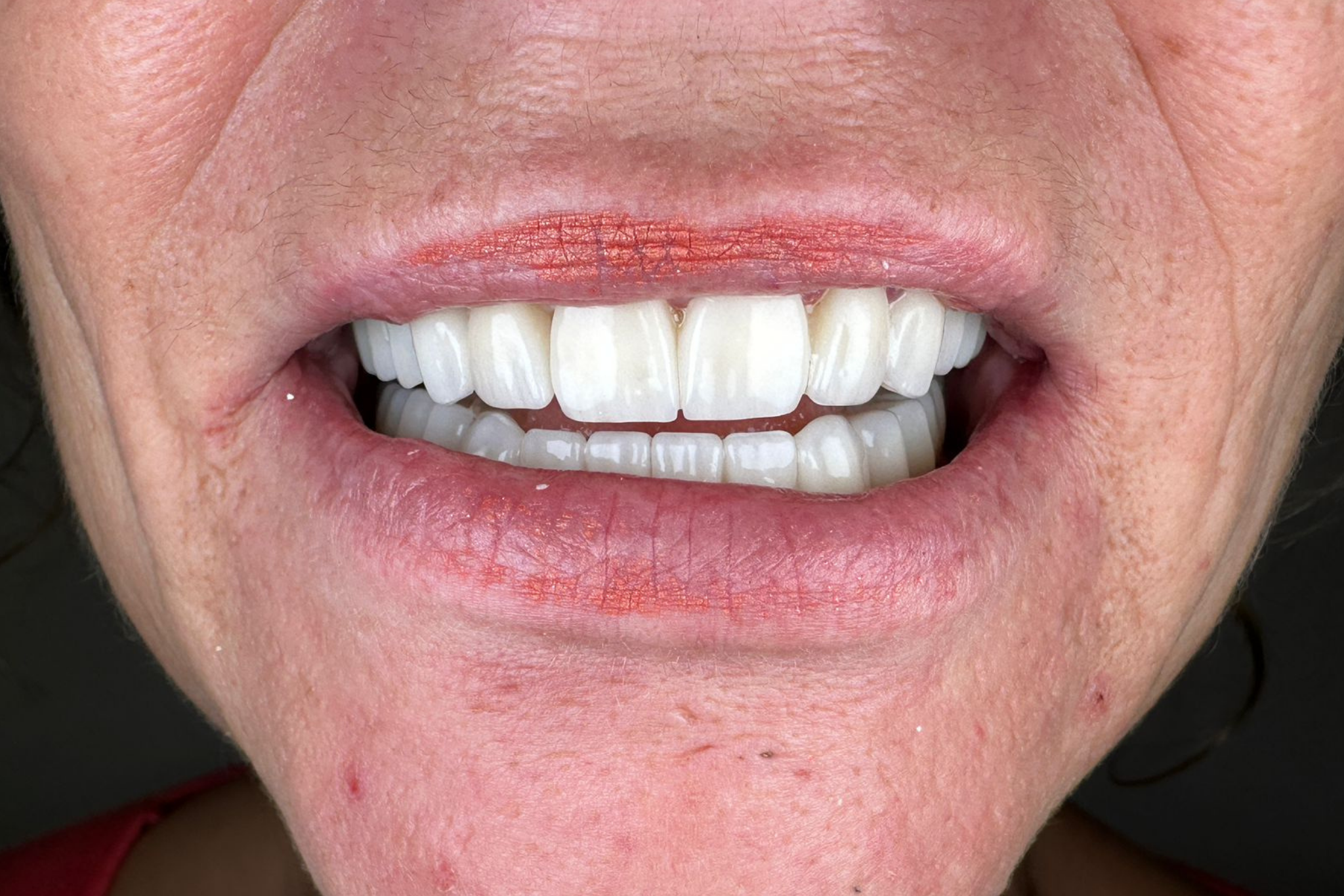 After Zirconia Crown Treatment